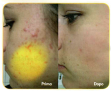Risultati dopo trattamento con luce polarizzata sull'acne