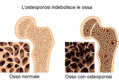Osteoporosi differenze 